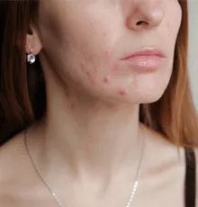 A female with acne on her chin